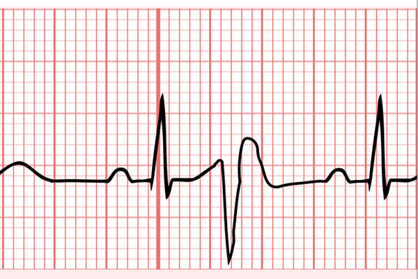 EKG - Rhythmusstörungen